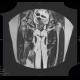 Osteolytic changes of femur: MRI - Magnetic Resonance Imaging
